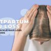 Postpartum Hair Loss How to Tackle Hair Loss In New Moms